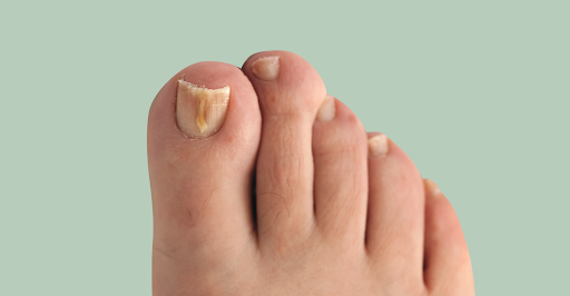 Nail fungal condition is also a common condition