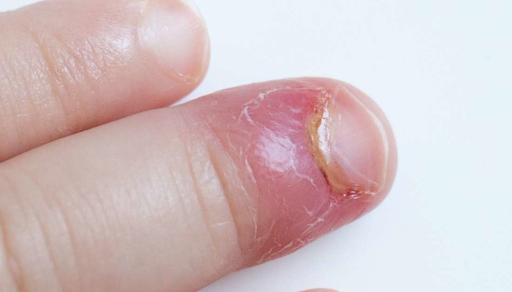 Infected nail beds may damage the cuticle, causing your press-on nails painful. 